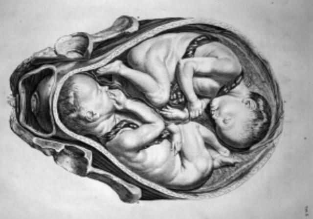 A drawing of twins in utero.